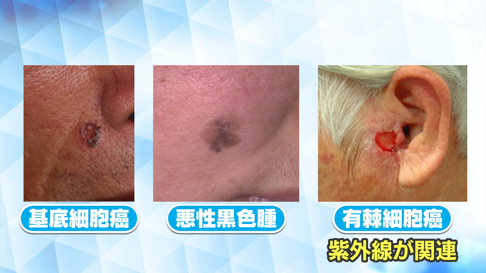 紫外線が皮膚に与える影響は?皮膚がんとホクロの見分け方は?皮膚がんに注意が必要な年代は?|いっちゃん☆メディコ|KNB WEB|北日本放送 ...